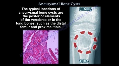 An Aneurysmal Bone Cyst What Is It Symptoms Etiology Types Pathology Treatment