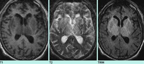 Проверьте 'hirnvenenthrombose' перевод на английский. Abb. 8 8 T1-, T2- und TIRM-gewichtete MRT eines ausgedehnten, nahezu... | Download Scientific ...