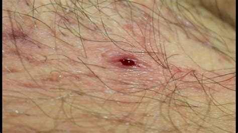 Pimple Pop And Ingrown Hair Youtube