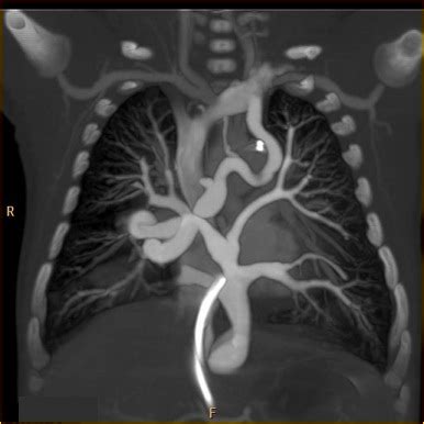 He or she will also close off. Total anomalous pulmonary venous connection MRI - wikidoc