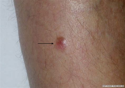 Stage 3 and 4 stage 3 melanoma has spread away from the primary tumor or into nearby lymph nodes. Diagnose: Diagnosed With Melanoma