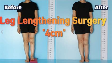 Leg Length Discrepancy Leg Lengthening Surgery Precice 4cm Youtube