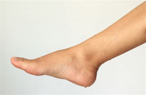 Sweating Disorders — Fitzroy Foot And Ankle Clinic