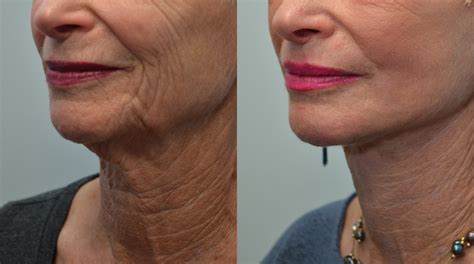 Patient 4588422 Co2 Laser Resurfacing Gallery Tansavatdi Cosmetic And Reconstructive Surgery