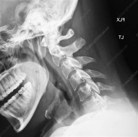 Normal Cervical Spine X Ray Stock Image C0393922 Science Photo