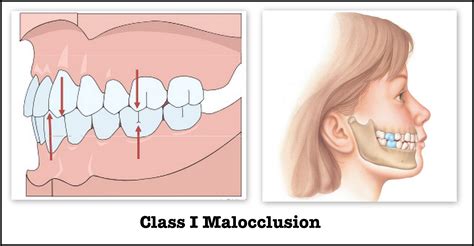 Angles Classification Of Malocclusion Dentodontics