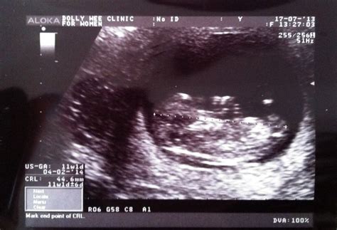Our Little Precious One 11 Weeks 2nd Prenatal Checkup