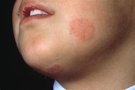 Dangers Of Ringworm Disease In Babies Know The Symptoms And Causes