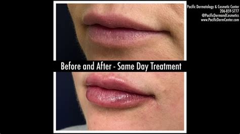 One Syringe Of Lip Filler Demo Video Using Juvederm Ultra Xc Seattle