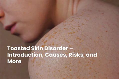 Toasted Skin Disorder Introduction Causes Risks And More