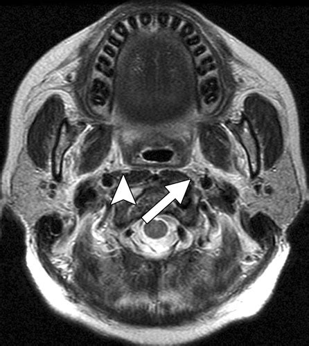 Radiologic Criteria Of Retropharyngeal Lymph Node Metastasis In