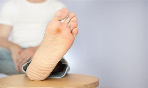 What Increases My Risk Of Diabetic Ulcers On The Foot Midwest Institute For Non Surgical