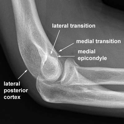The Lateral Elbow WikiRadiography
