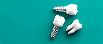 Dental Missing Teeth Alternatives Implants Replacing Wellness