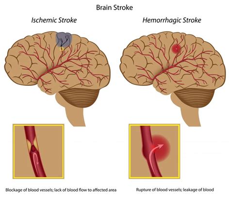 What Is The Difference Between An Ischemic Stroke And A Hemorrhagic Stroke