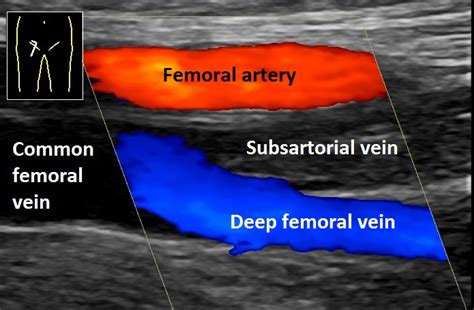 Fileultrasonography Of Deep Vein Thrombosis Of The Femoral Vein Annotated Wikimedia Commons