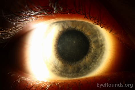 Avellino type II granular corneal dystrophy. EyeRounds.org ...