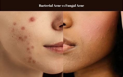 Fungal Acne Vs Bacterial Acne Identifying And Treating Different Acne