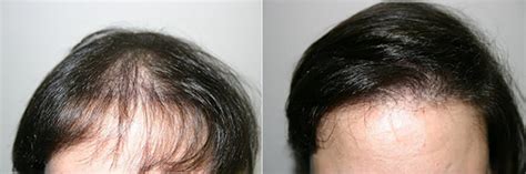 Hair transplant before and after photos from real patients. Female Hair Loss Patient 5 | Limmer Hair Transplant Center