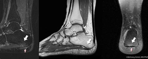 Mri and ultrasound have been utilised in the assessment of the plantar intrinsic foot muscles. Roentgen Ray Reader: Plantar Fasciitis: MRI Findings