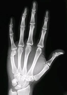 Occasionally it is used to refer to fractures of the 4th metacarpal as well. Boxers Fracture Doctor Los Angeles, Boxers Fracture ...
