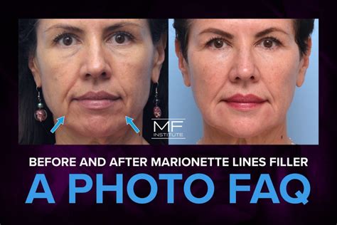Before And After Marionette Lines Filler A Photo Faq Mabrie Facial