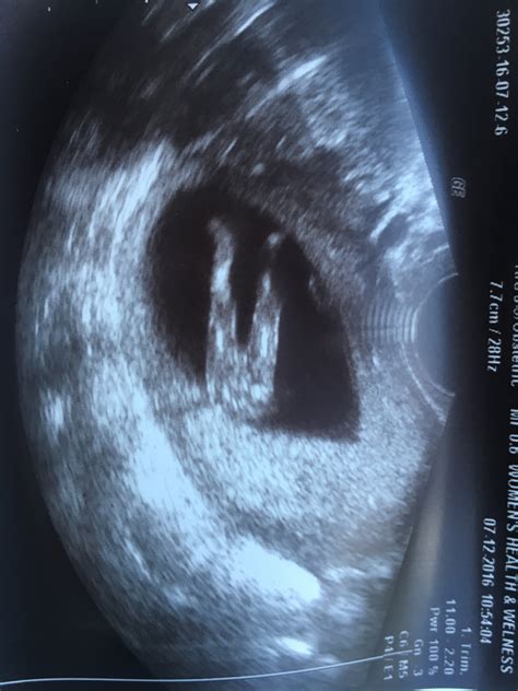 Your baby looks like a tiny formed human, and your uterus is finally. Boy or girl?! 12 week ultrasound picture!