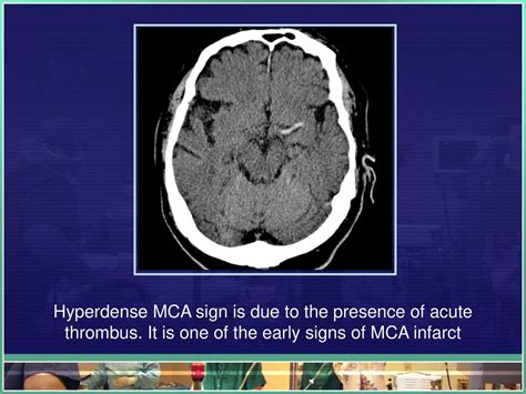 Mca Sign In Ct Brain The Hyperdense Vessel Sign Is Most Widely