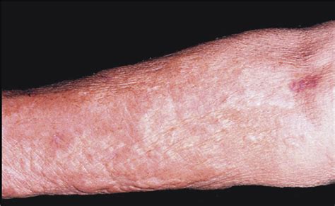 Dermatological Disease In Patients With Ckd American Journal Of