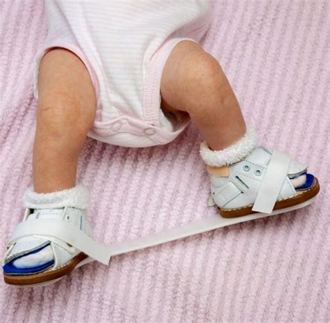 How To Tell If Your Baby Has Clubfoot 2024 Guide Honestly Fit