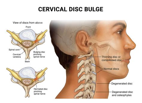 All You Need To Know About Bulging Discs In The Cervical Spine