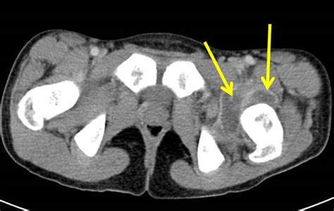 Septic Arthritis Of The Hip Radiology Cases