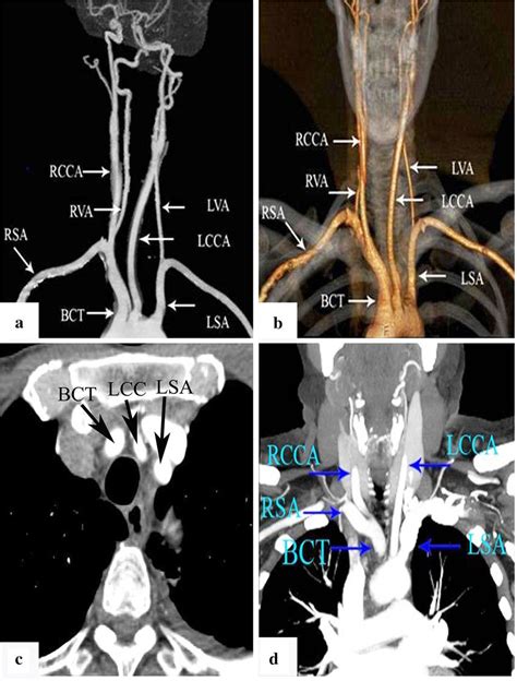 Classical Branching Pattern Of The Aortic Arch In A Conventional