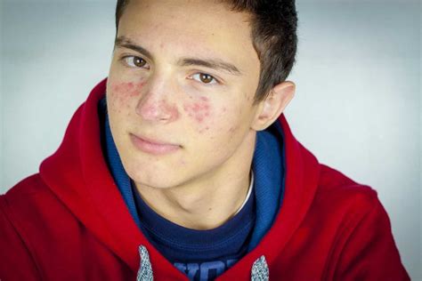Acne The Causes And Successful Treatment Health And Aesthetics