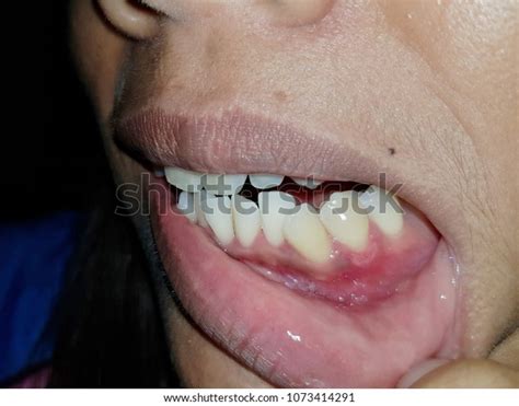 Aphthous Stomatitis On Gum Area 스톡 사진 1073414291 Shutterstock