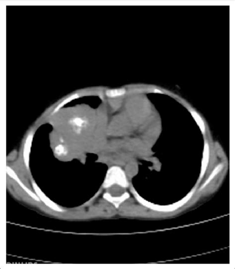 Contrast Enhanced Ct Of Chest Showing Heterogeneously Enhancing Mass