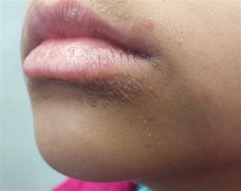 Tiny Pimples On Edge Of Lips