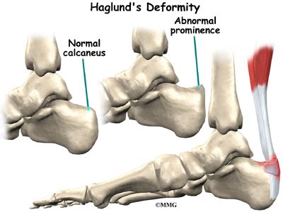 Haglund S Deformity Singapore Orthopaedic Centre