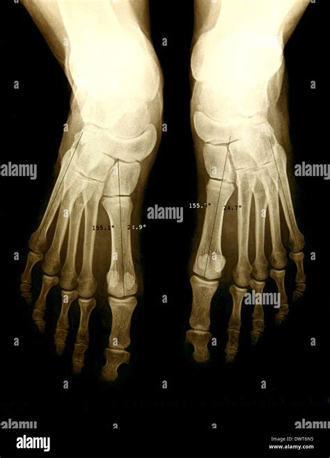 Foot X Ray Stock Photo Alamy