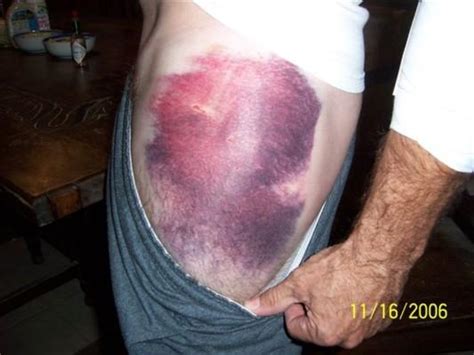 How Long Does It Take For A Leg Hematoma To Heal