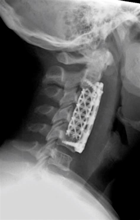 Safety And Efficacy Of Multilevel Acdf Accf Surgery Anterior Cervical