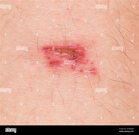 Wound On Skin Stock Photo Alamy