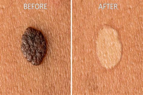 How To Make Your Product The Ferrari Of Mole Removal Red Light Therapy