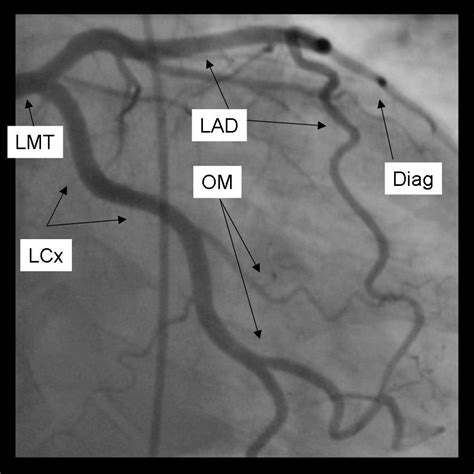 coronary angiographic projections wikidoc