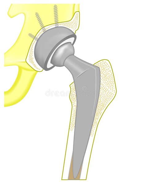 Hip Replacement Total Stock Illustrations 62 Hip Replacement Total