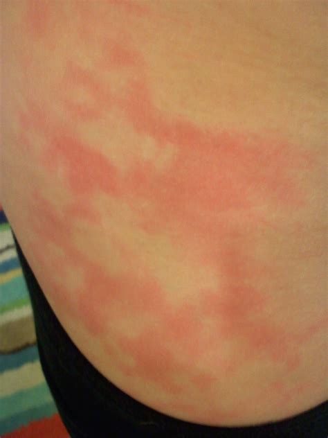 Red Blotches On Skin Not Itchy On Arms