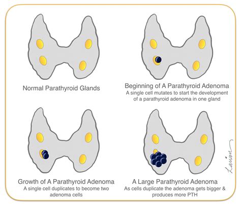 Parathyroid Adenoma Growth Hyperparathyroidism Surgery Dr Babak Larian