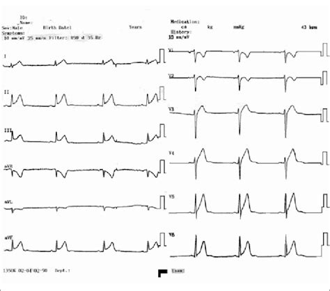Electrocardiograph Of A Patient With 2 Mm St Segment Elevation D2 D3