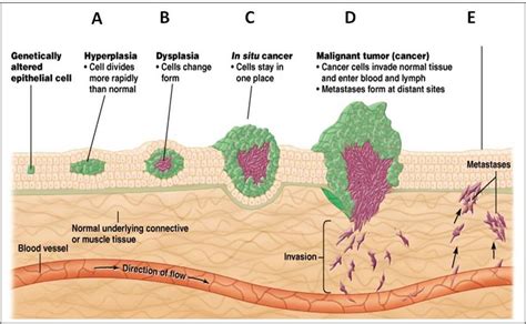 Stages Of Tumor Development And Mechanism Of Metastasis Download