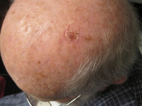 Actinic Keratosis Treatment Over The Counter All Natural Perrin Naturals
